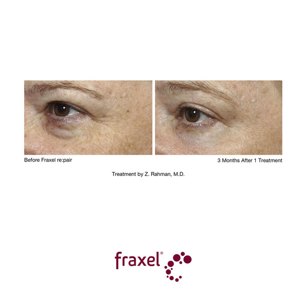 Vorher / Nachher Bilder von beispielhaften Fraxel re:pair Behandlungen