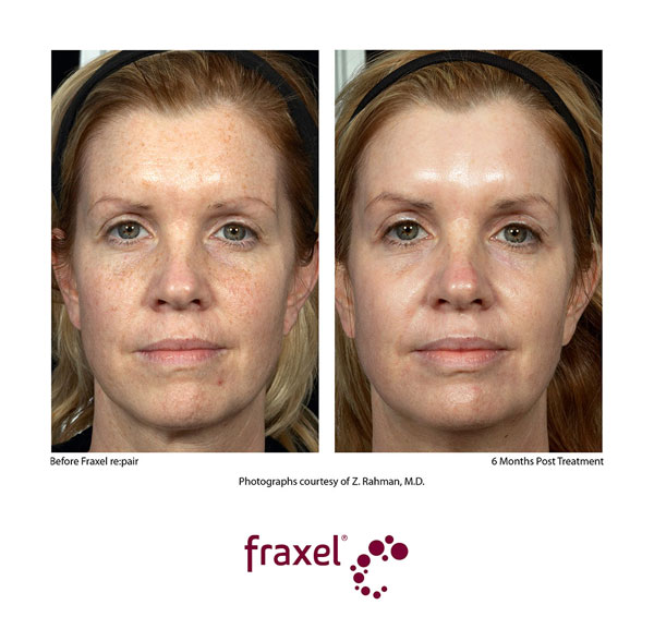 Vorher / Nachher Bilder von beispielhaften Fraxel re:pair Behandlungen