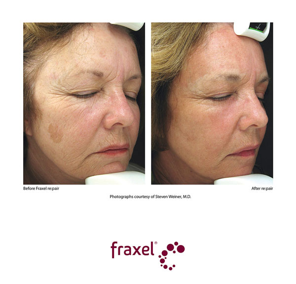 Vorher / Nachher Bilder von beispielhaften Fraxel re:pair Behandlungen
