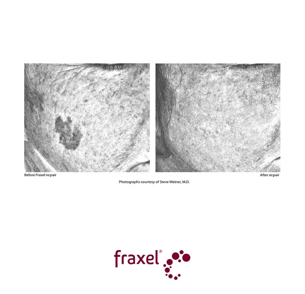 Vorher / Nachher Bilder von beispielhaften Fraxel re:pair Behandlungen
