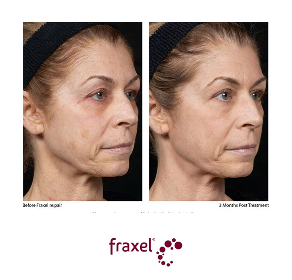 Vorher / Nachher Bilder von beispielhaften Fraxel re:pair Behandlungen