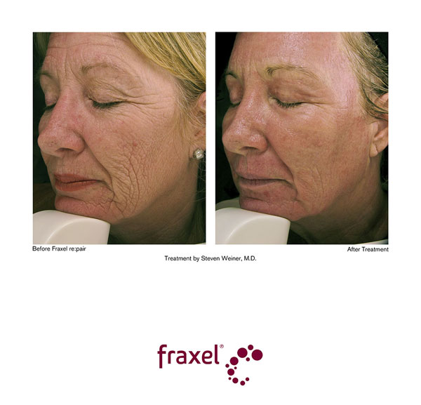 Vorher / Nachher Bilder von beispielhaften Fraxel re:pair Behandlungen